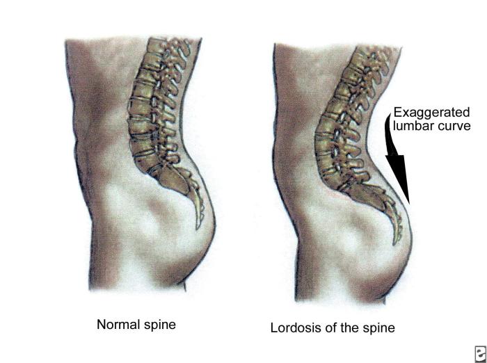 curvature of spine 14354